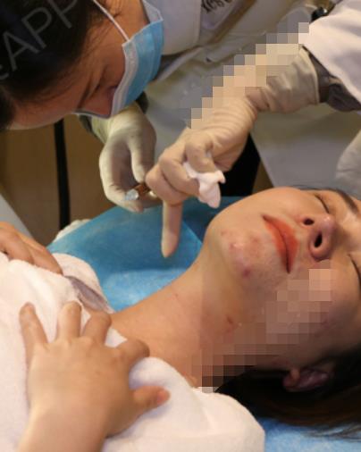 匡妗妮的去頸紋術前照片