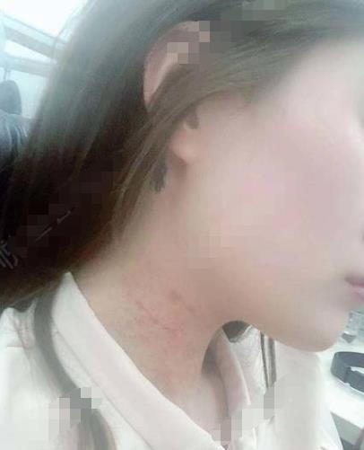 竺豪的去頸紋術前照片