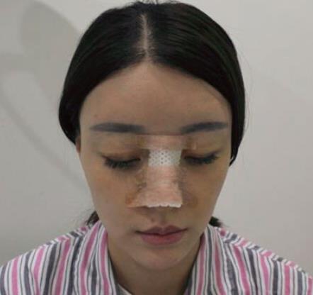 毛睿豐的隆鼻修復術前照片