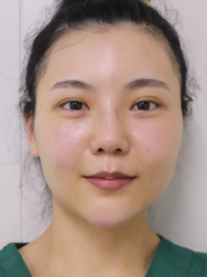 冷兆合的磨骨瘦臉術前照片