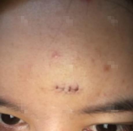 林熙麟的祛疤術(shù)前照片