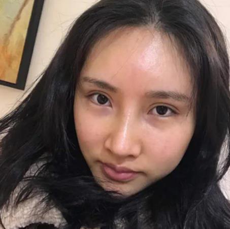 榮峻熙的磨骨瘦臉術(shù)前照片