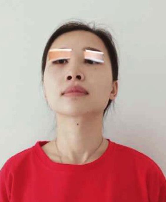 陸董煜的埋線雙眼皮術(shù)前照片