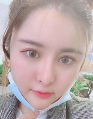 倪姝彥的面部吸脂瘦臉術(shù)前照片