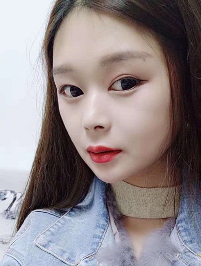 梁聾廬的面部拉皮術(shù)前照片