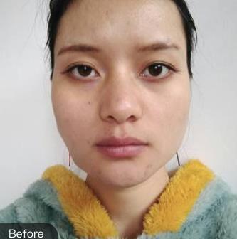 繆熠名的激光去眼袋術(shù)前照片