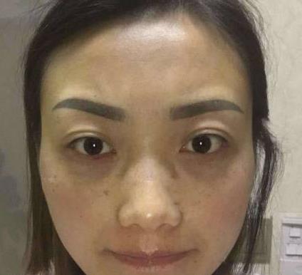 蕭戰(zhàn)天的去眼袋術(shù)前照片