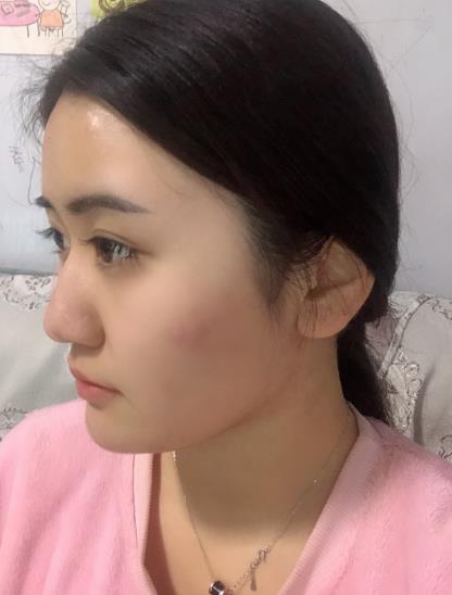 魚(yú)世豪的瘦臉針術(shù)前照片