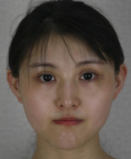 及景蕤的瘦臉針術(shù)前照片