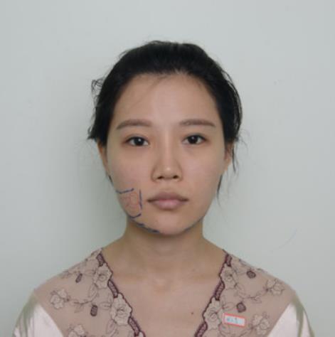 楊振邦的面部吸脂瘦臉術(shù)前照片