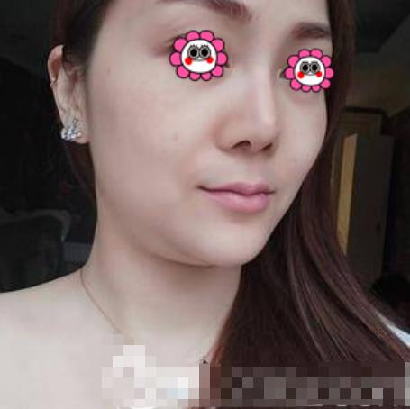 慕雨山的瘦臉針術前照片