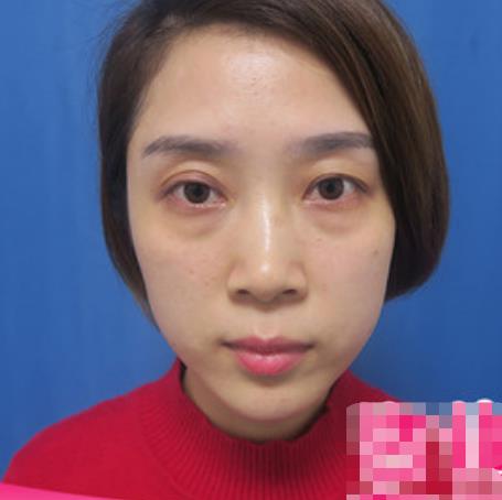 榮澤瑞的去眼袋術前照片