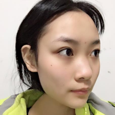 曾慶鵬的隆鼻術(shù)前照片