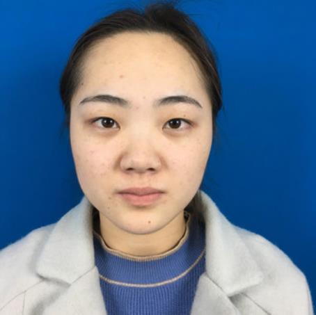 孟慶鴻的全切雙眼皮術(shù)前照片