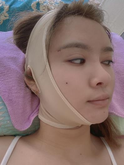 江盼盼的下頜角磨骨術前照片