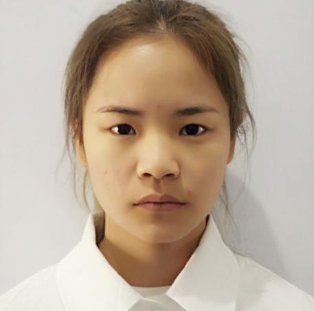 幸裕博的埋線雙眼皮術(shù)前照片