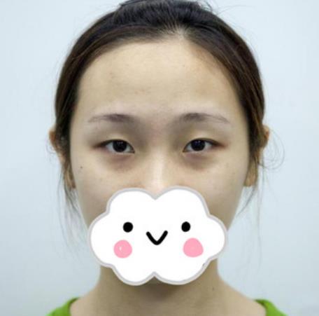 梁懿凡的雙眼皮術(shù)前照片