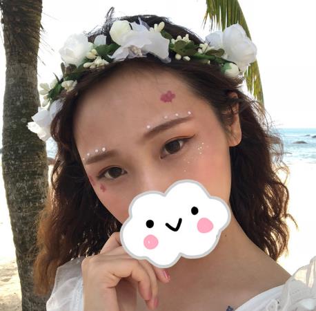 梁懿凡的雙眼皮術(shù)后照片