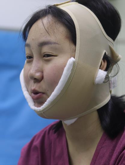 彭程宇的下頜角磨骨術(shù)前照片