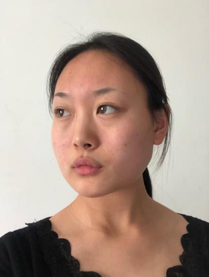 孔德菠的下頜角磨骨術(shù)前照片