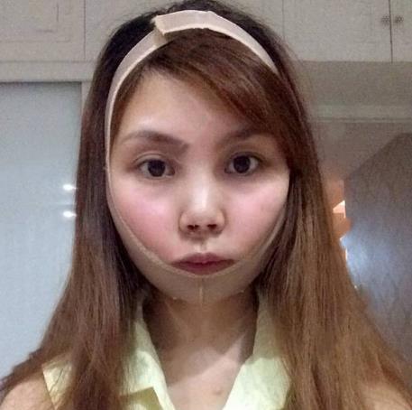 管星月的面部吸脂術(shù)前照片