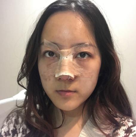 姚鷹矗的隆鼻術(shù)前照片