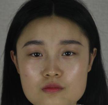 沈煒勛的下頜角磨骨術(shù)前照