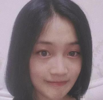 沈煒勛的下頜角磨骨術(shù)后照