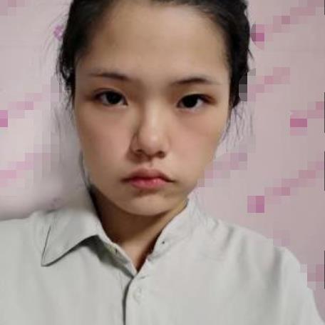 溫雨諾的面部拉皮術前照片