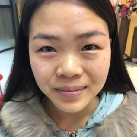 嚴(yán)奕文的隆鼻術(shù)前照片