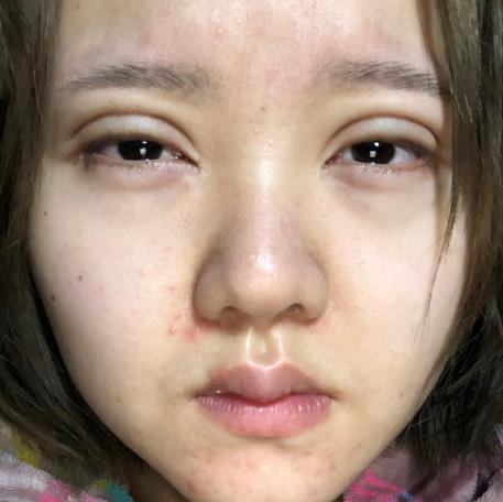 柴景曜的雙眼皮術(shù)前照片