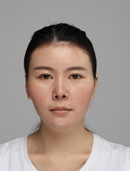 金通運的下頜角磨骨術(shù)前照片