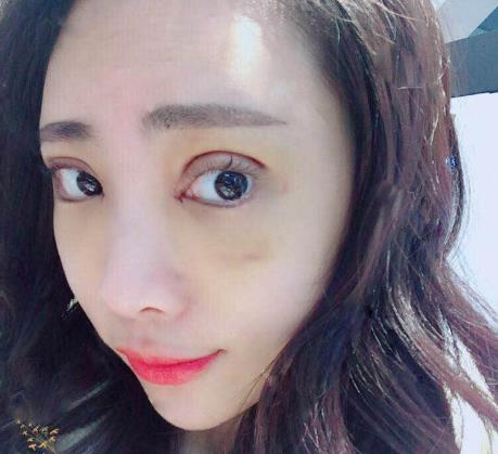 饒博磊的雙眼皮術(shù)前照片