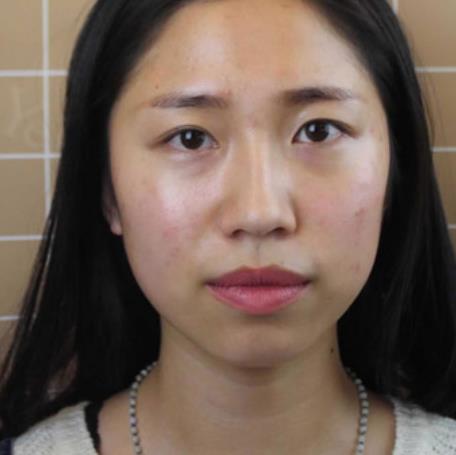 黃子鈞的雙眼皮術(shù)前照片