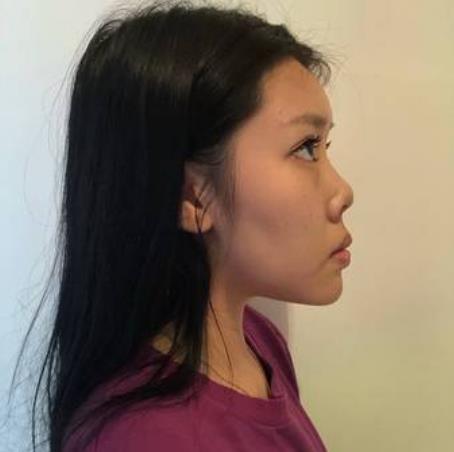 藺雨澤的隆鼻術(shù)前照片