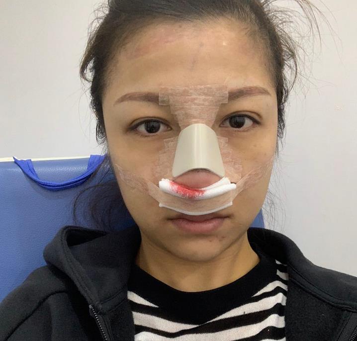 柴德容的鼻修復術前照片