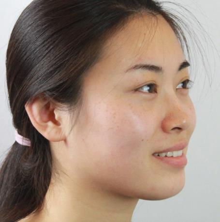 莊靈蕓的皮秒祛斑術(shù)前照片