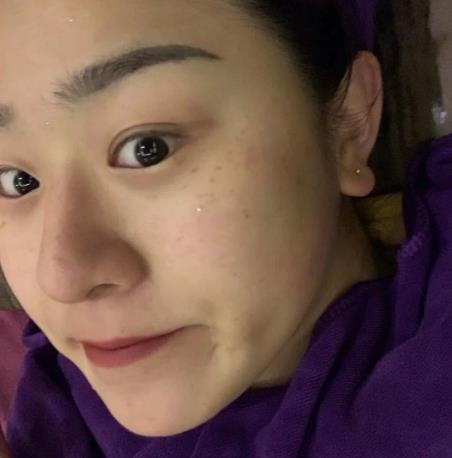 臧瑞的皮秒祛斑術(shù)前照片