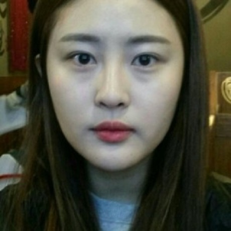 于寧的去眼角紋術(shù)前照片