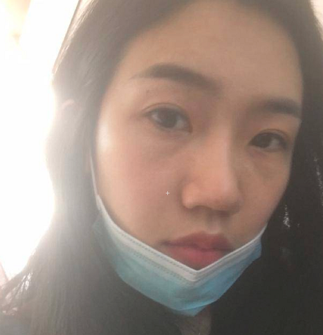 單志剛的去眼角紋術(shù)前照片