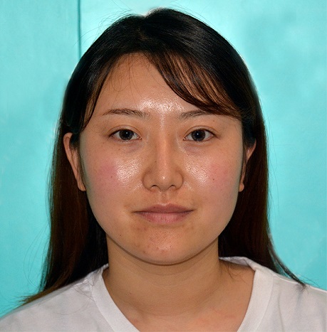 麻慶的去眼角紋術(shù)前照片