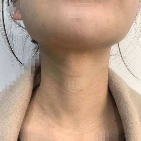 尹肖霞的去頸紋術(shù)前照