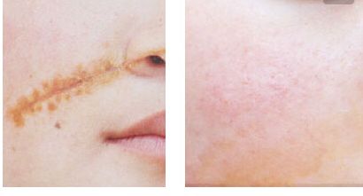 武漢協(xié)和楊杰雙眼皮手術(shù)效果如何？費用昂貴嗎？賞析真實案例及價格清單參考