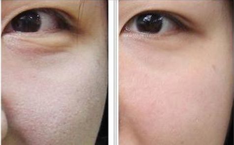 長沙湘雅醫(yī)院豐胸效果觸動(dòng)人心！2023奇跡曝光