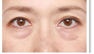 南昌二附院易陽艷雙眼皮手術效果欣賞，術后一個月如何恢復？