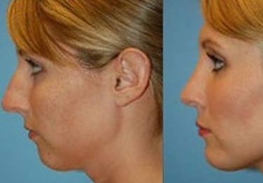 揭秘北京協(xié)和王巍醫(yī)生的婦科醫(yī)術(shù)和私密整形術(shù)效果