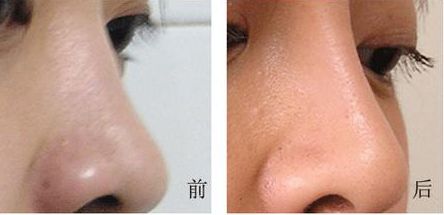 西部戰(zhàn)區(qū)總醫(yī)院美容科術后效果驚艷，獨家案例曝光