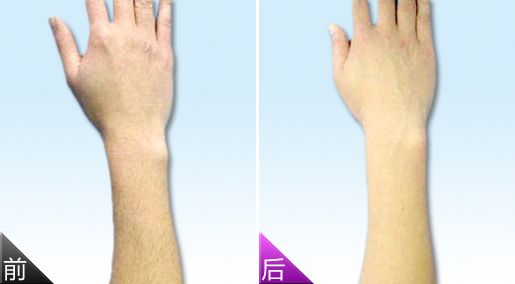 北京白云整形醫(yī)生楊曉楠雙眼皮修復案例賞析