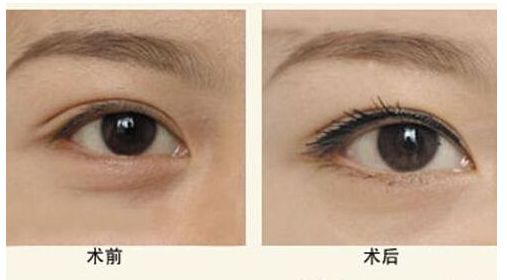 鄭州二附院韓國技術(shù)墊鼻真實感受揭秘