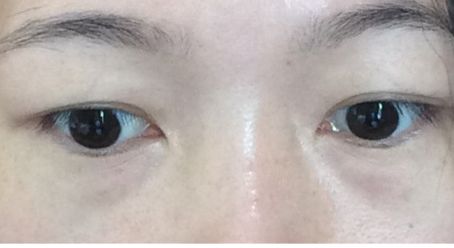 西南醫(yī)院最佳雙眼皮醫(yī)生推薦！王量、李世榮經(jīng)驗(yàn)分享&眼部整形案例揭秘